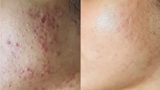 Acne scars Treatment acnescars [upl. by Cathrin68]