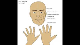 Acromegaly definition amp Meaning Health Healthcare Healthtips [upl. by Lenrow]