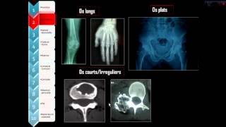 Approche diagnostique radiographique des tumeurs osseuses [upl. by Eenor241]