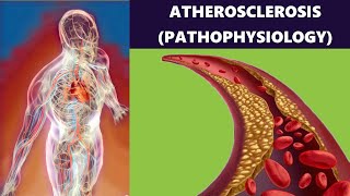 Atherosclerosis – Artery Disease Plaque Formation Risk Factors and Prevention Pathophysiology [upl. by Normak624]