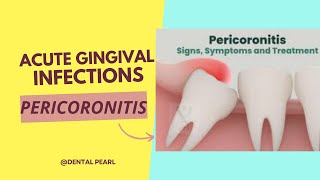 ACUTE GINGIVAL INFECTION PERICORONITIS [upl. by Nnaecyoj862]