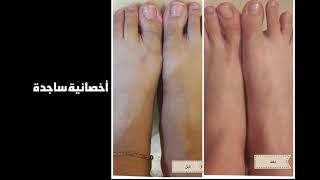 mesopeel melanoplus before and after نتائج تقشير ميلانوبلس [upl. by Sarchet345]