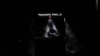 Hypoplastic posterior mitral valve leaflet  APLAX [upl. by Fridell]