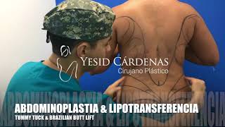 Liposuccion y abdominoplastia Medellin Colombia [upl. by Leodora]