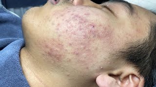 ACNE TREATMENT VU QUYNH MI Blackheads On Boy Face 2024 [upl. by Lounge]