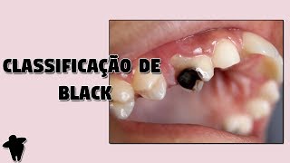 Classificação de Black  Nomenclatura e Classificação de Cavidades  Aula de Dentística DE 15 [upl. by Paris]