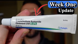 Week 1 of Using Steroid Cream for My Psoriasis [upl. by Acilejna]