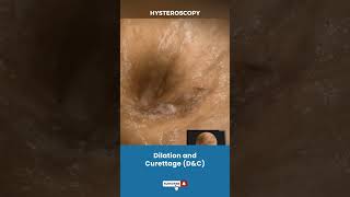 बच्चेदानी Uterus का Dilation और Curettage  Procedure for removing unwanted tissue in uterus [upl. by Aennyl]