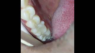 Root canal treatment  composite fillings in treating irreversible pulpitis severe toothache [upl. by Barclay]