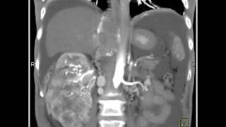 Abdomen Kidney Renal cell carcinoma invades the IVC and extends into the right atrium2 of 2 [upl. by Sirah]