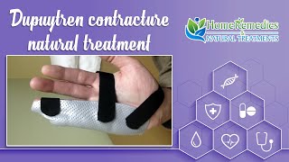 Dupuytren’s contracture Natural treatment  Natural treatments and home remedies [upl. by Nyra193]