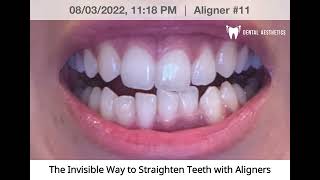 Aligners Journey  Invisible Braces Before And After [upl. by Hertzfeld]