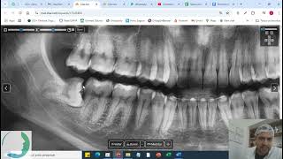 MayLuiFraCar  Exodontia dos sisos  Biomaterial [upl. by Asihtal]