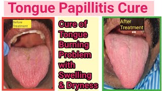 Tongue infectionGlossitis how to cure Fungal infection inside mouthTongue burning sensation cure [upl. by Prevot]