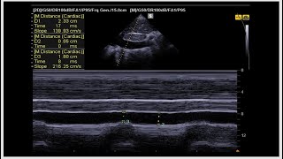 Step by step approach of hypoxic and shock patient by advanced critical care US [upl. by Pokorny]