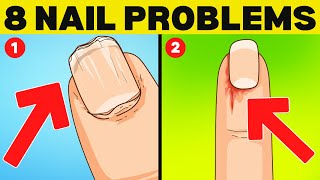 Top 8 Nail Signs of Health Problems Uncovering The Causes [upl. by Henebry]