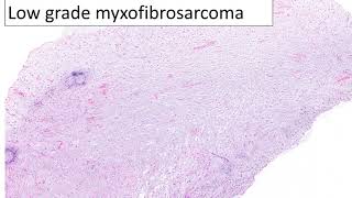 A guide to low grade myxoid sarcomas [upl. by Ameline]