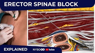 Erector Spinae Plane Block  Regional anesthesia Crash course with Dr Hadzic [upl. by Hales]