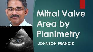 Mitral Valve Area by Planimetry on Echocardiogram [upl. by Dotson470]