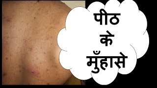 पीठ के मुँहासे  back acne  truncal acne hindi  डॉ आँचल पन्त [upl. by Greenburg353]