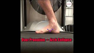 Understanding Over Pronation How it Leads to Collapsed Arches and Heel Pain [upl. by Symer]