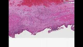 Histopathology GallbladderChronic cholecystitis [upl. by Atinreb]