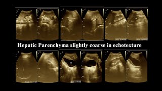 Coarse hepatic parenchymal  Ultrasonography report  liver disease  Amader Hospital  P1 [upl. by Grossman151]