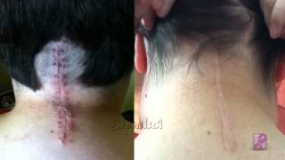 Chiari Malformation 1 Year PostOp [upl. by Thorbert208]