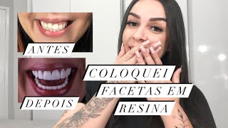 COLOQUEI FACETAS EM RESINA [upl. by Plossl]