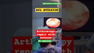 ACL AVULSION FIXATION SURGERY IN JAIPUR [upl. by Susette229]