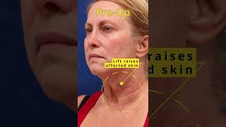 One Year Post FaceliftDeep Neck Lift Examining Poikiloderma [upl. by Lysander]