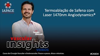 Caso 4 Termoablação de Safena com Laser de 1470nm Angiodynamics [upl. by Girand716]