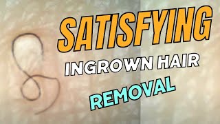 Satisfying Ingrown Hair Removal [upl. by Scever]