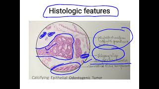 calcifying epithelial odontogenic tumour [upl. by Luanne]