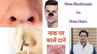 Trichostasis Spinulosa  Nose Blackheads  Nose Hairs  Nose Acne नाक पर काले दाने और बाल nosehair [upl. by Ahsain]