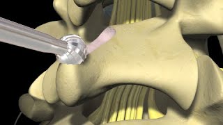 Low Back Pain Lumbar Laminectomy Surgery [upl. by Heall]