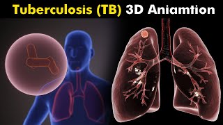 What Happens in Tuberculosis TB  3D Animation  Types Causes Symptoms Treatment UrduHindi [upl. by Aihsenat]