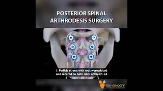 Posterior Spinal Arthrodesis Surgery [upl. by Jemina]