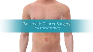 Distal Pancreatectomy How the Procedure Is Performed [upl. by Atiuqet]