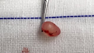 Epididymal Cyst [upl. by Georgianna]