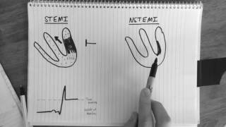 STsegment changes in STEMI amp NSTEMI explained [upl. by Swithin161]