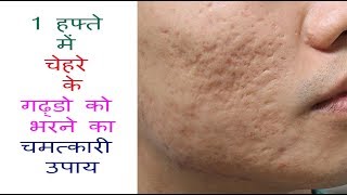 1 हफ्ते में चेहरे के गढ़्डो को हटाने का चमत्कारी उपाय  Acne Scars Home Remedies That Work Fast [upl. by Chuu]