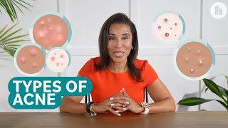 The Different Types of Acne and How to Treat Them [upl. by Eilsil365]