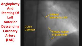 Angioplasty And Stenting Of Left Anterior Descending Coronary Artery [upl. by Aitahs]