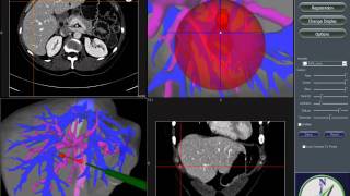 ImageGuided Liver Ablation [upl. by Fritz150]