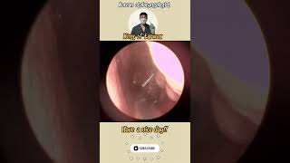 귀지형 콧물 부비동염 축농증 비염 코청소 이비인후과 rhinorrhea rhinitis sinusitis asmr ENT entdoctor [upl. by Skyler]