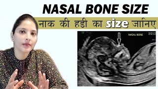 अल्ट्रासाउंड में नाक की हड्डी का साइज कितना होना चाहिए Absent Nasal Bone [upl. by Ube]