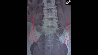 Osteitis Condensans Ilii vs Sacroiliitis [upl. by Landahl297]