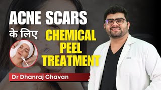 Acne Scars के लिए Chemical Peel Treatment  Dr Dhanraj Chavan  Clear Skin Pune [upl. by Ytram930]