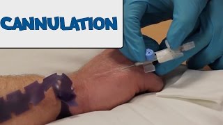 How to Perform Cannulation  OSCE Guide old version  UKMLA  CPSA [upl. by Middlesworth906]